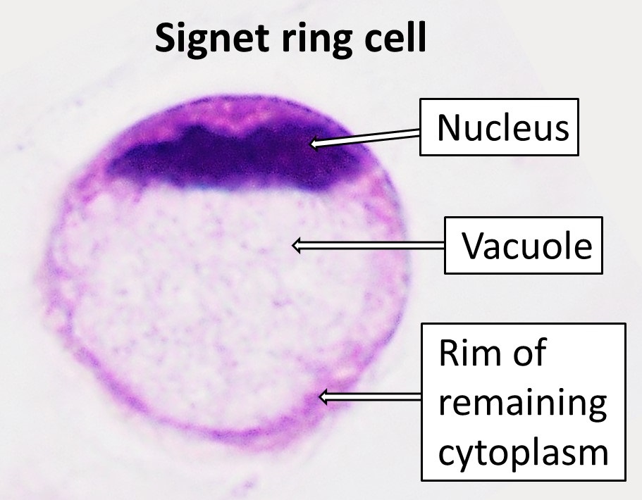 Il Carcinoma Polmonare Primitivo a Cellule ad Anello con Castone: Una Rara Entità e un Caso Clinico Singolare