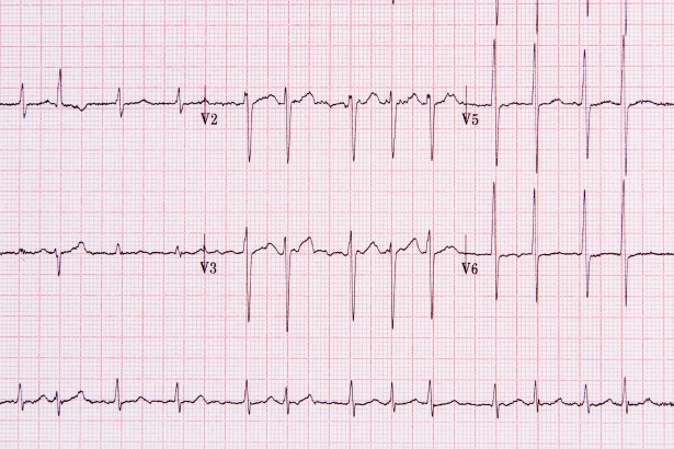 Allerta COVID nella Cardiochirurgia del Moscati: Quattro Contagiati ad Avellino