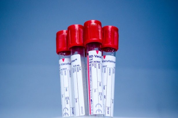 Ospedale Moscati Avvia Studi Clinici per Anticorpo Monoclonale Anti-Covid: Ricerca Volontari
